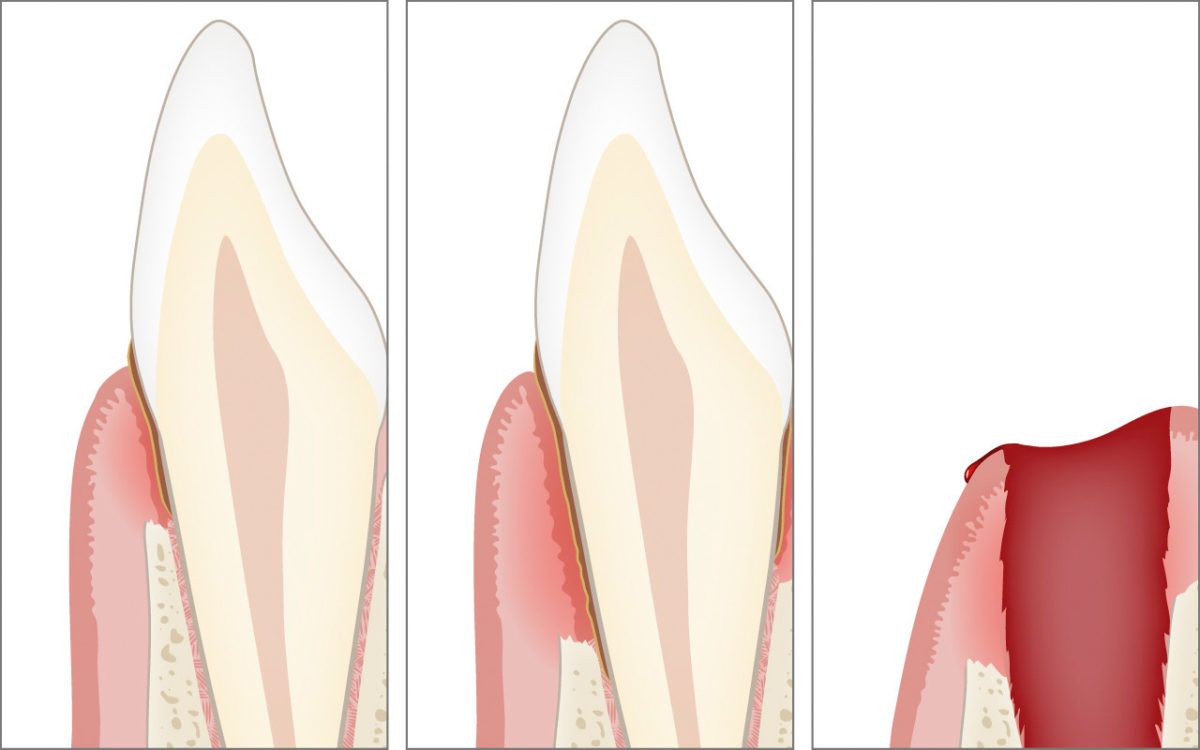 Bone loss, gum pockets, and tooth loss