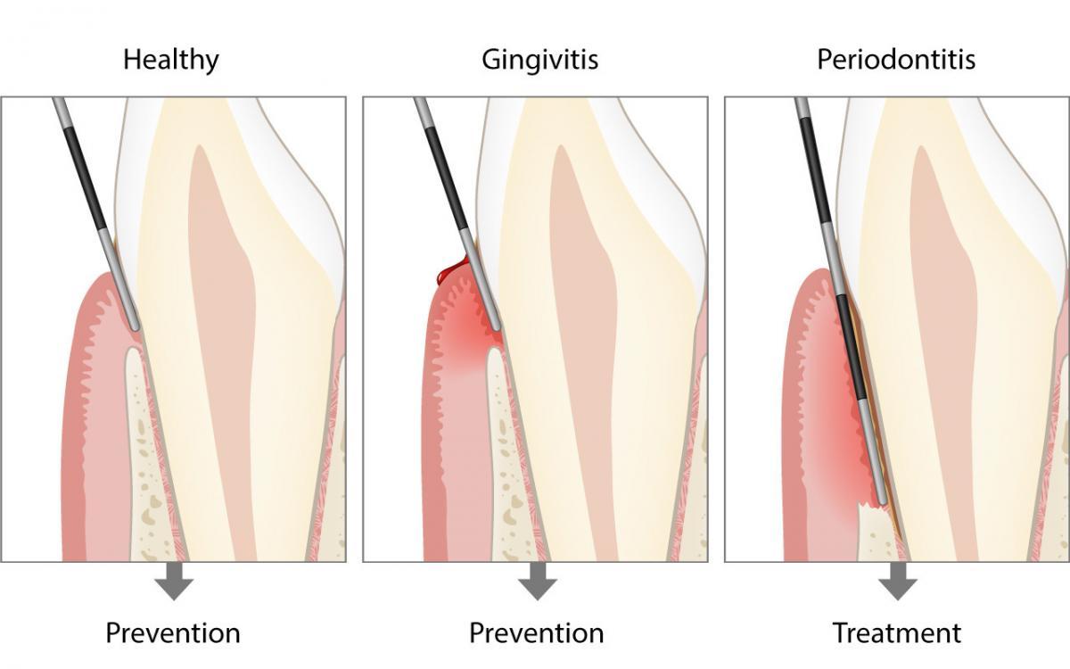 Basic periodontal examination