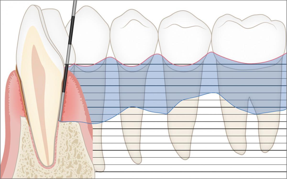 Periodontal chart
