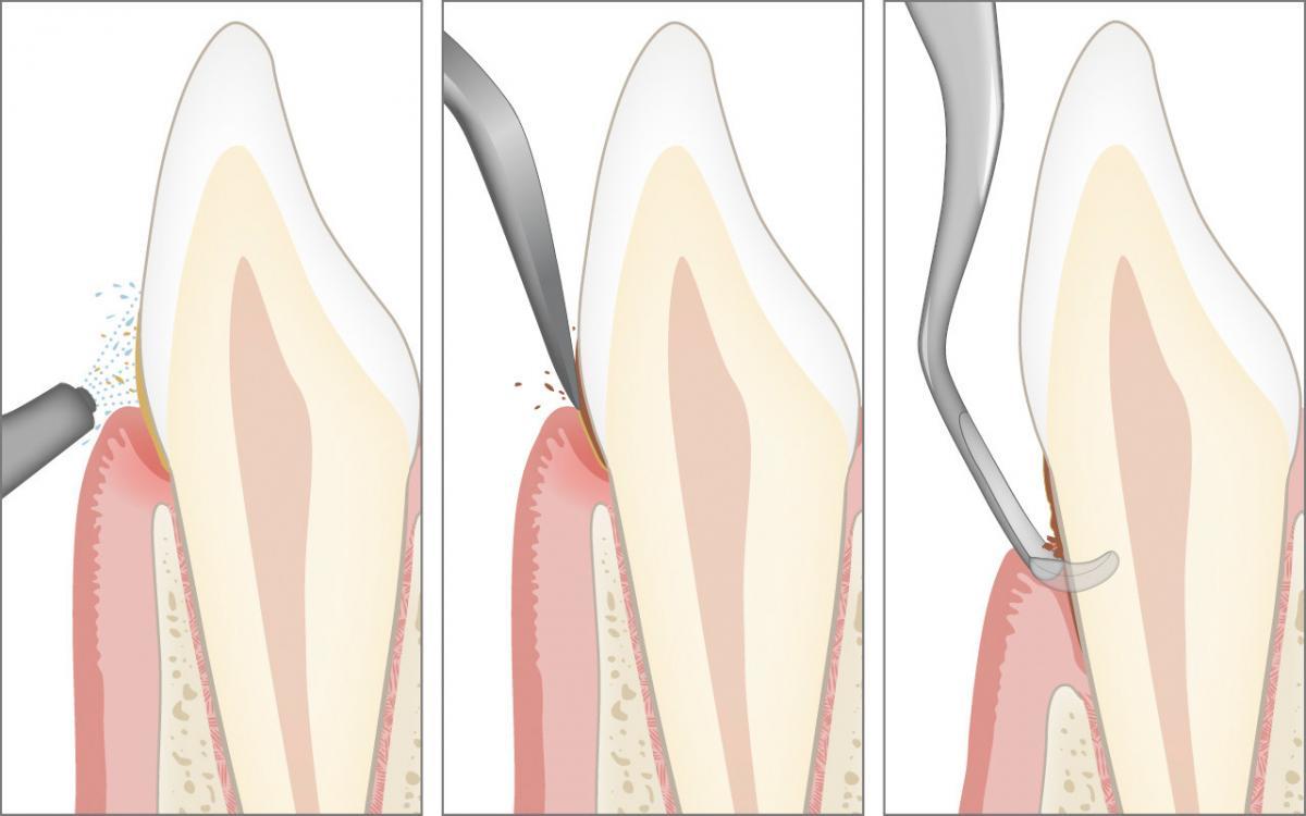 Regular professional teeth cleaning